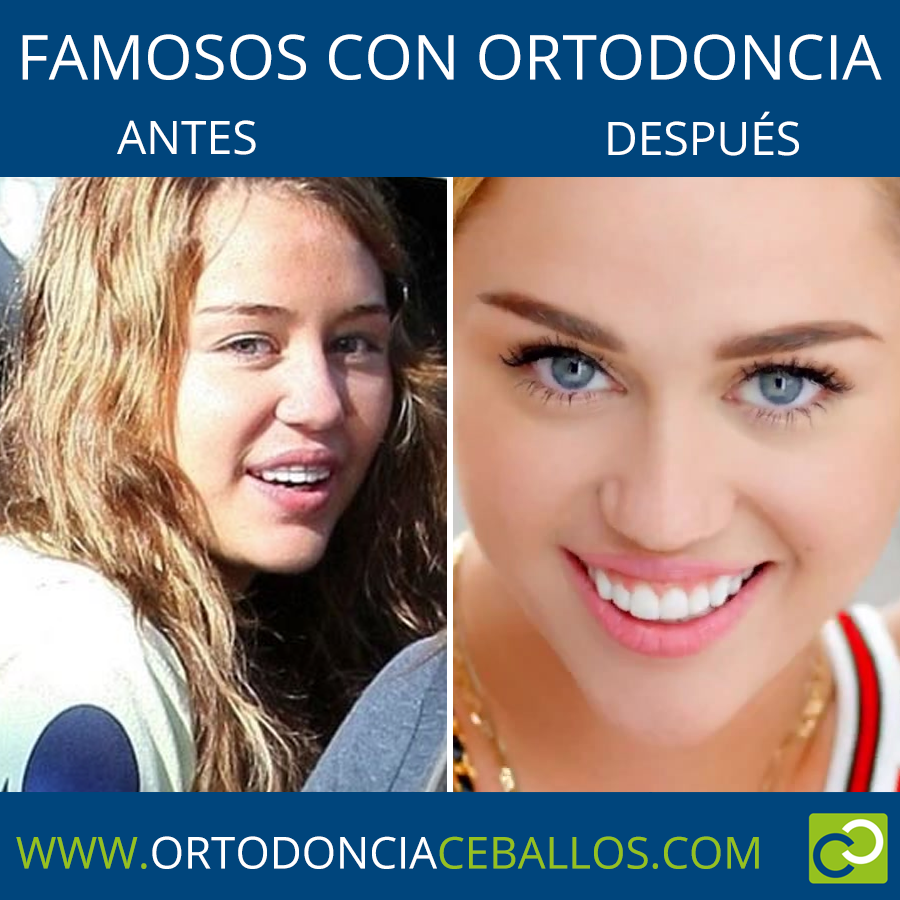FAMOSOS_CON_ORTODONCIA-MileyCyrus
