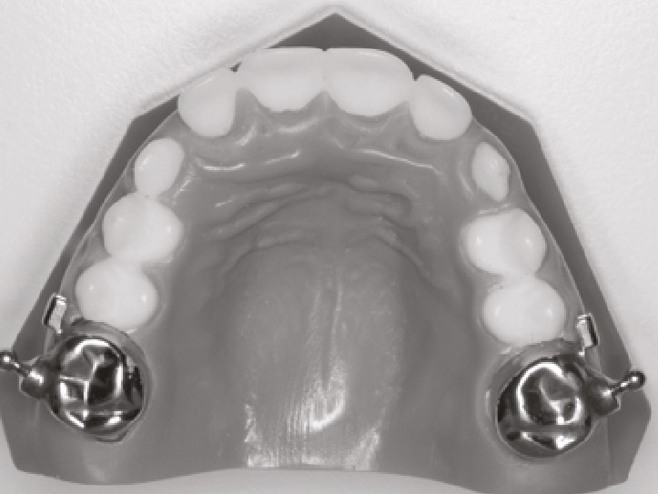 Parte superior: Coronas en molares de acero.
