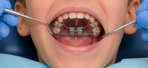 expansor dental en malaga