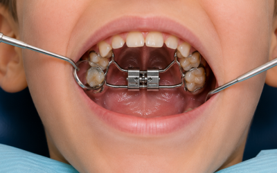 El aparato expansor en la boca de mi hijo: todo lo que debo saber
