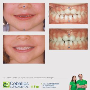 EXPANSOR DENTAL MALAGA