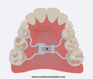 Expansor dental