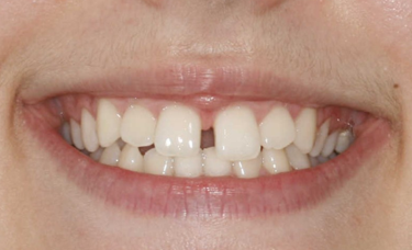 Paciente con diastema dental antes de iniciar el tratamiento