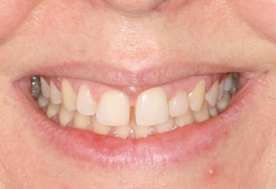Diastema dental 