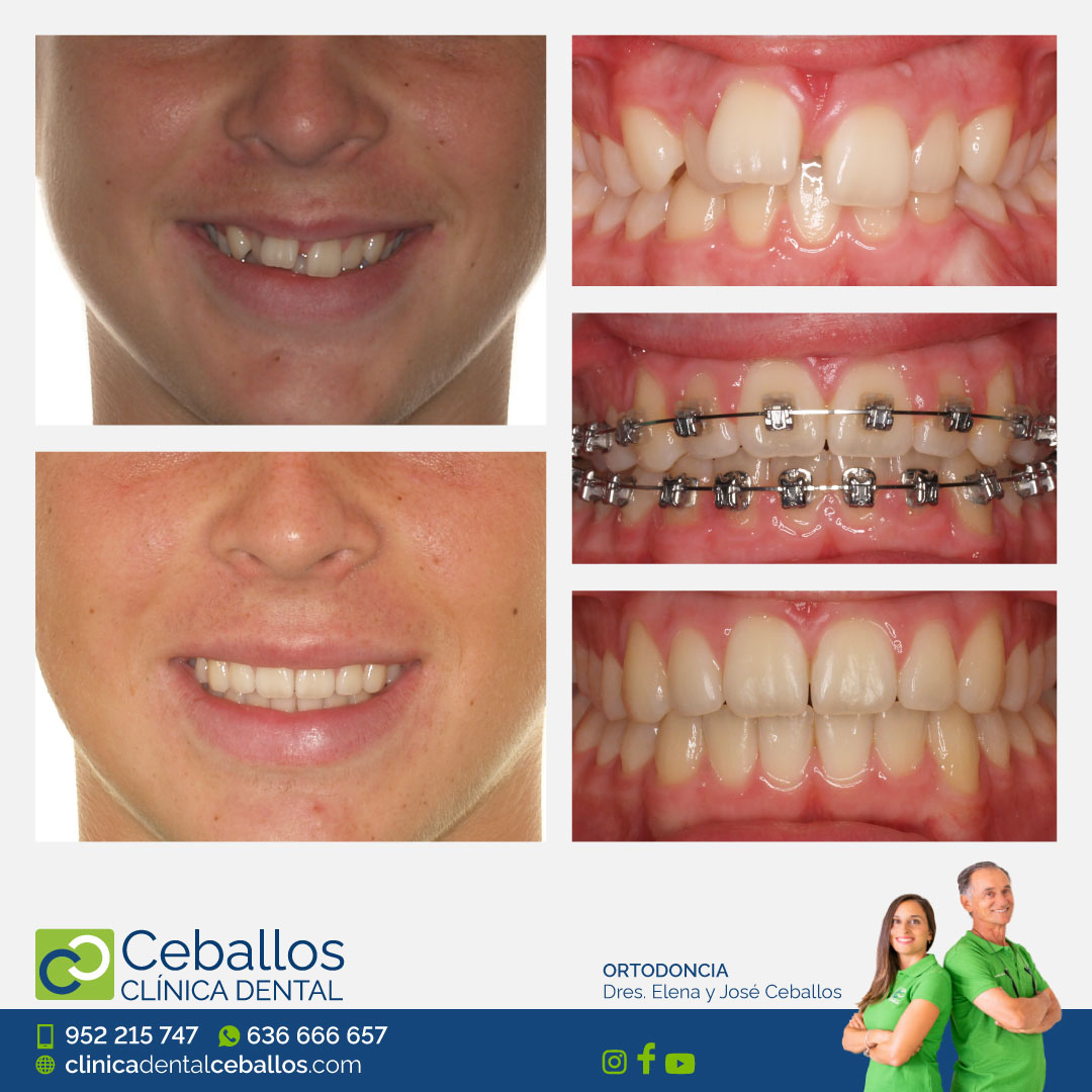Diastema dental tratamiento con ortodoncia