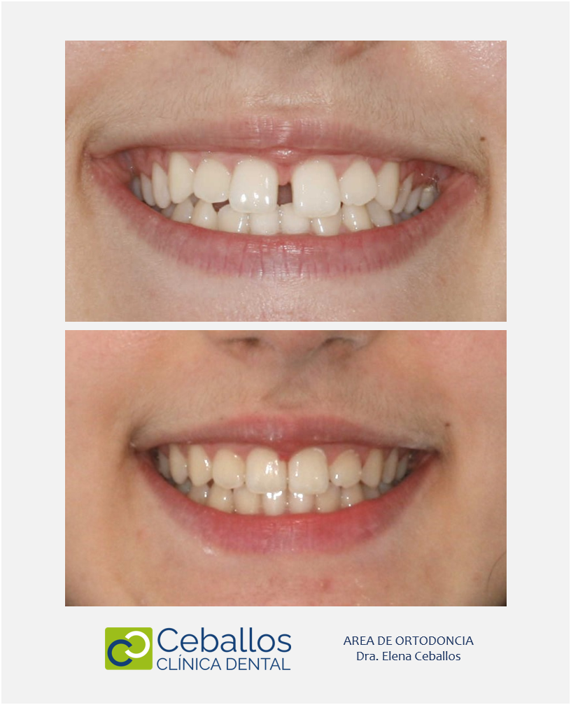 Diastema dental