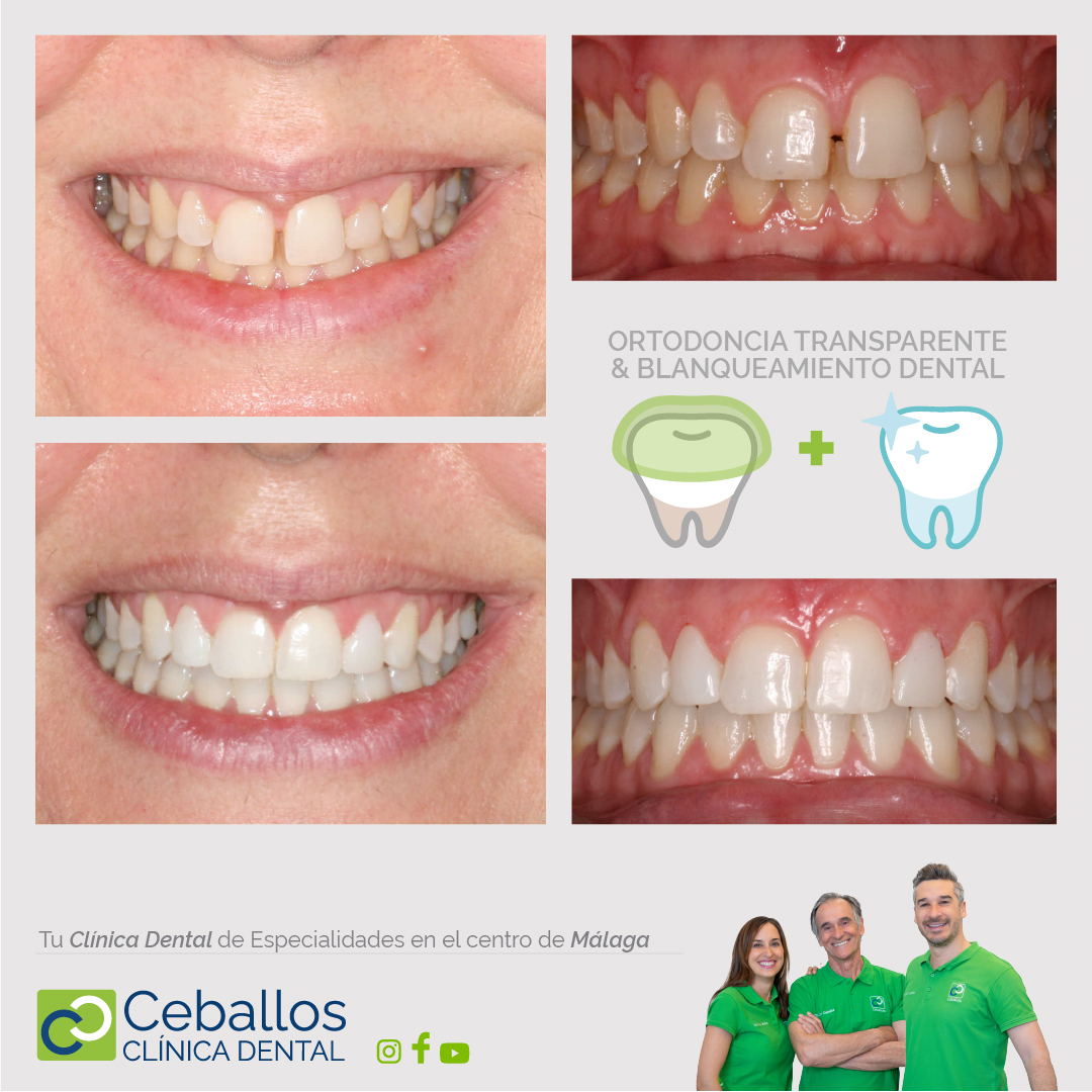Diastema dental tratamiento con ortodoncia