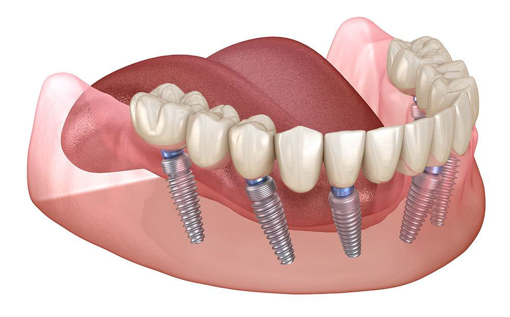 ¿Se puede fumar con implantes dentales?