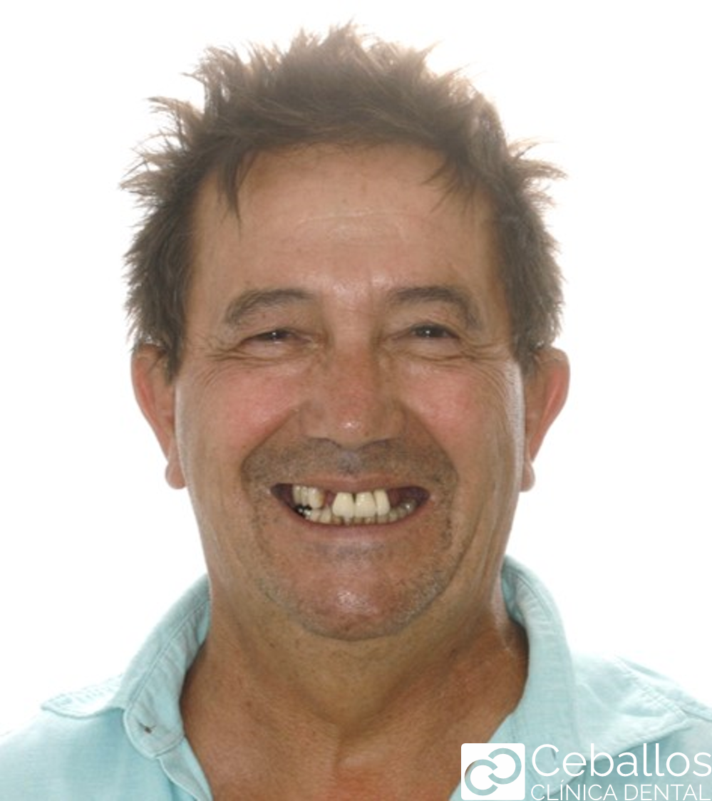 Método all on 4 para paciente con pérdida de dental