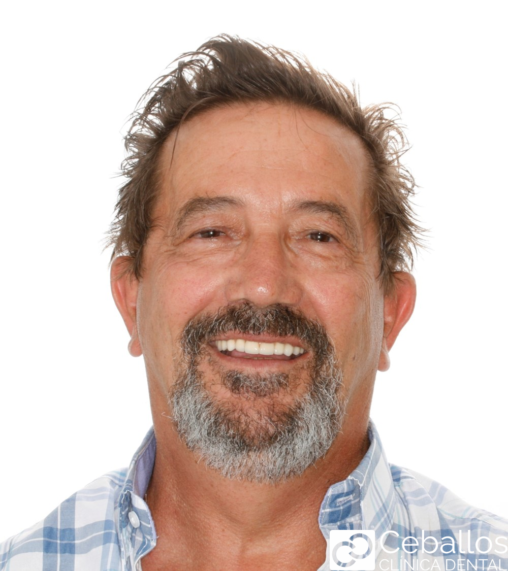 Metodo all on 4 a paciente para recuperar la sonrisa en un día