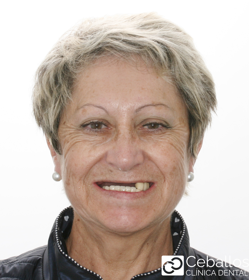 paciente antes de implantes dentales