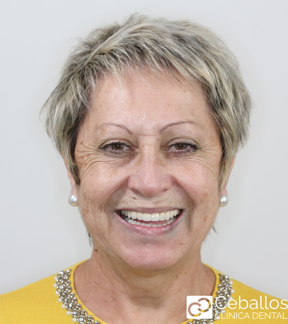 paciente después de tratamiento de implantes dentales