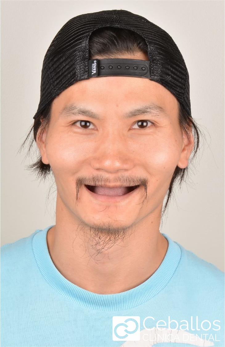 Paciente con problema de periodoncia, antes de implantes