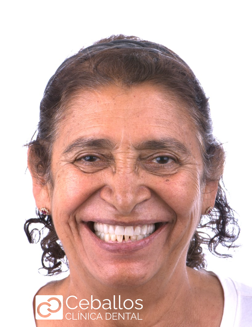 paciente después de implantes dentales