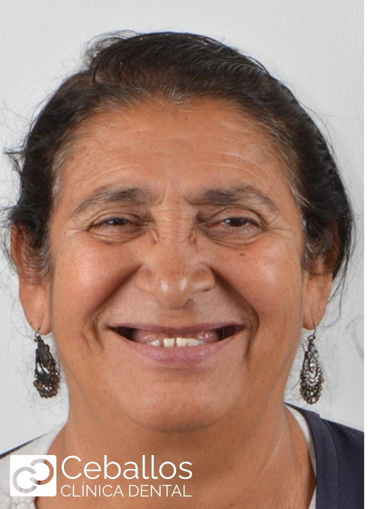 paciente con problemas dentales acude para evaluación de implantes dentales