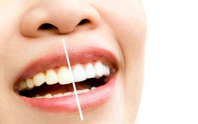 At-home teeth whitening with trays