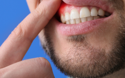 Recesión de encías: causas, síntomas y tratamientos