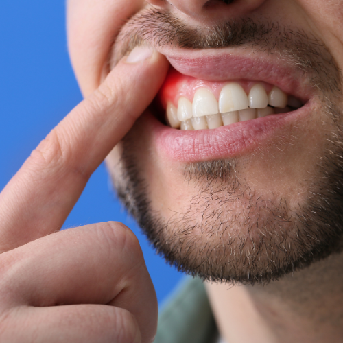 ¿Cuáles son los síntomas de la enfermedad periodontal?