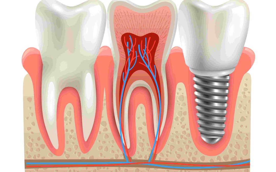 Periimplantitis, ¿Qué es y cómo tratarla?