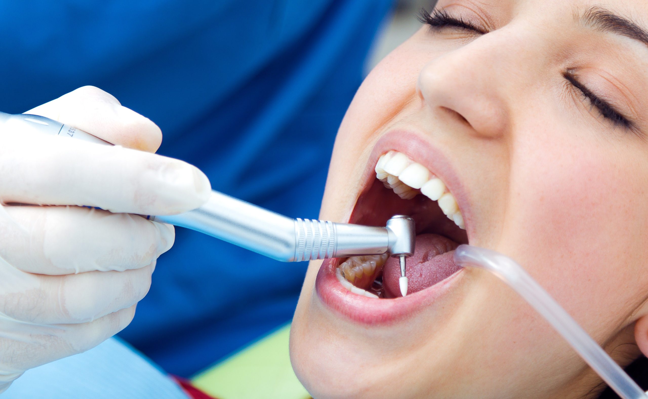 limpieza dental en malaga 