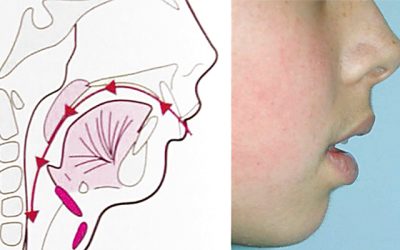 ¿Cuáles son las consecuencias de que los niños respiren por la boca?