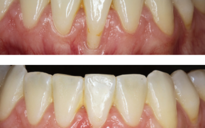 Injerto de encía en Málaga: Cómo recuperar tu salud gingival con el Dr. Ramón Ceballos