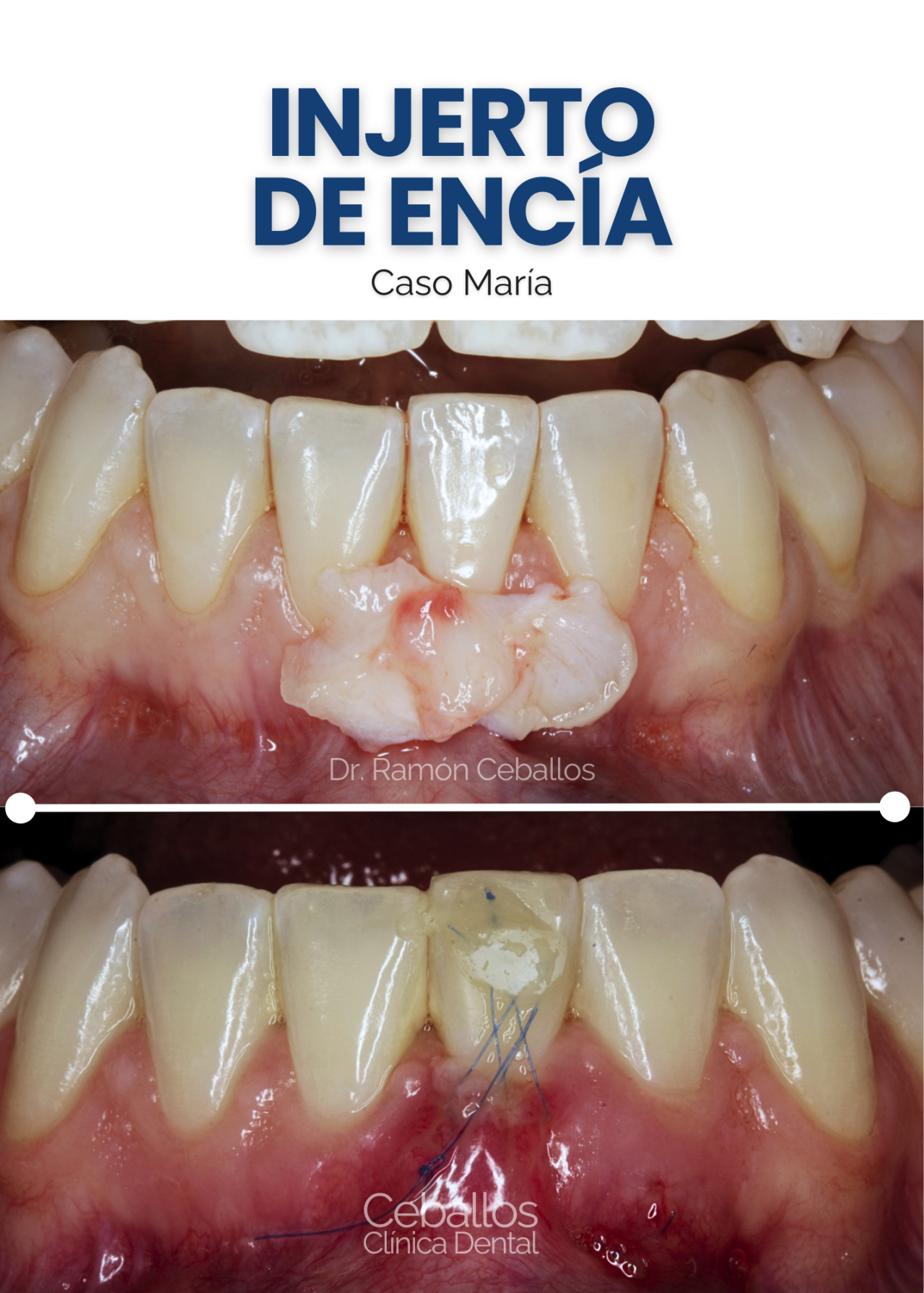 Injerto de encía en Málaga: Cómo recuperar tu salud gingival con el Dr ...