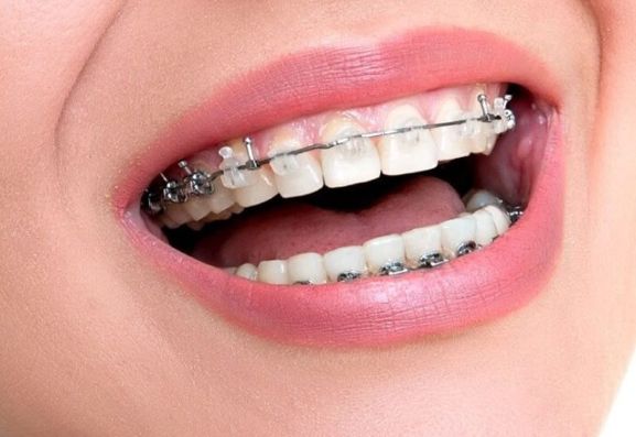 brackets malaga ortodoncia